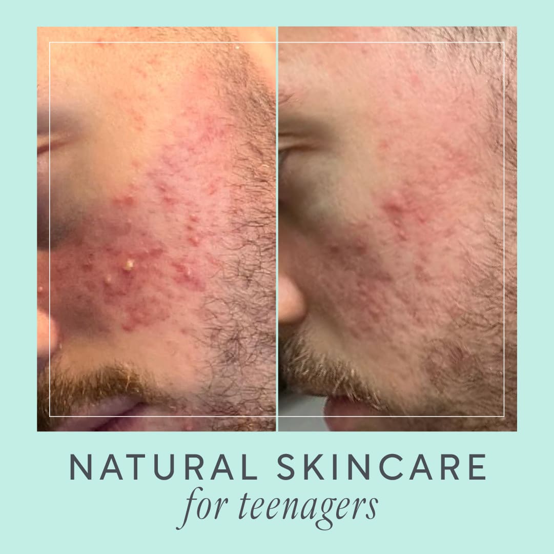Natural Teen skincare for Acne by Lucy Bee