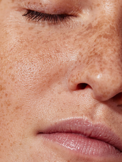Close-up of a person's face with visible skin texture and freckles.