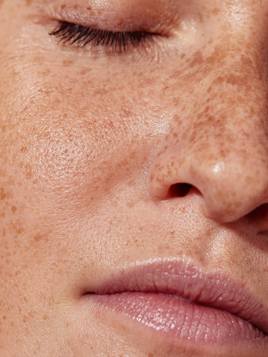 Close-up of a person's face with visible skin texture and freckles.